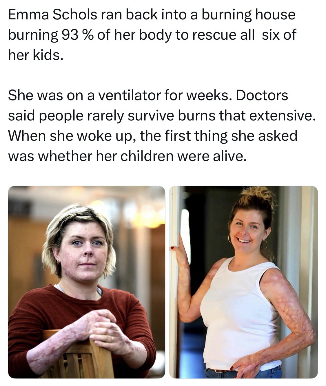 Emma Schols: The Mother Who Survived 93% Burns to Save Her Six Children