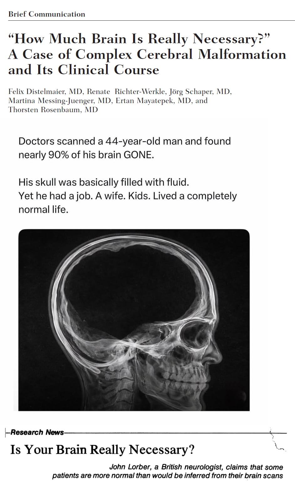 The Medical Case of a Man Living a Normal Life With 90% of His Brain Missing - Interesting on Aviaclip