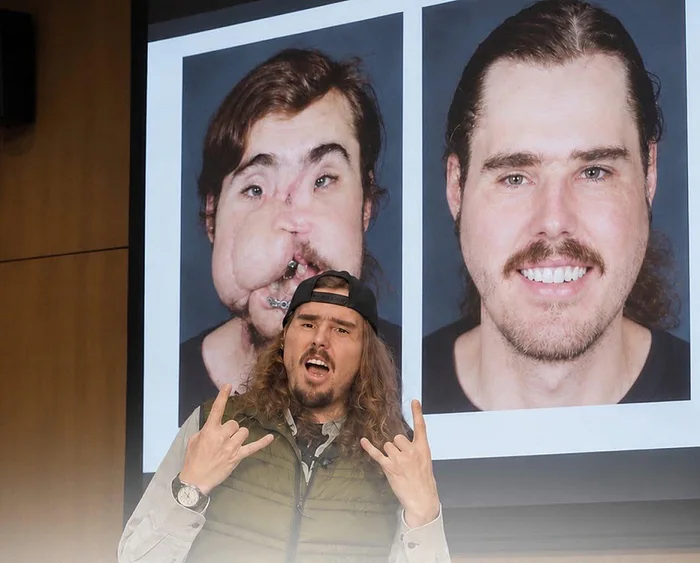 A Remarkable Medical Transformation: Cameron Underwood's Face Transplant Journey