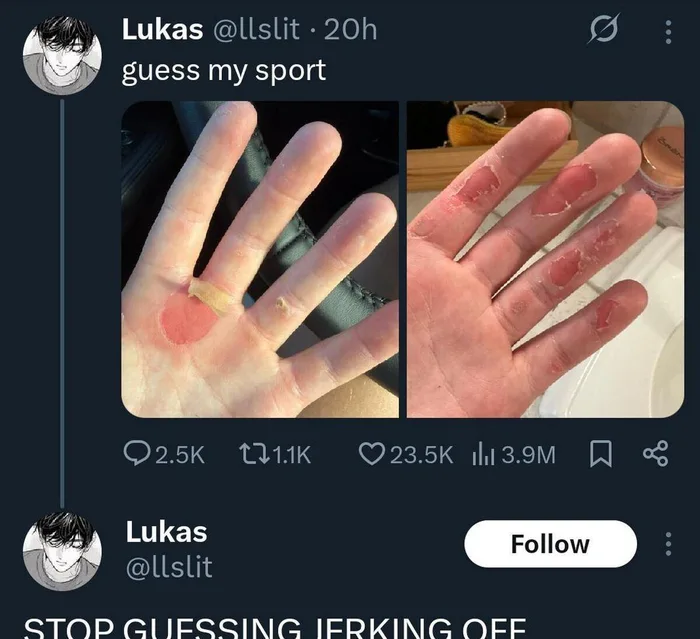 A Social Media User Challenges Followers to Guess Their Sport Based on Severe Hand Blisters