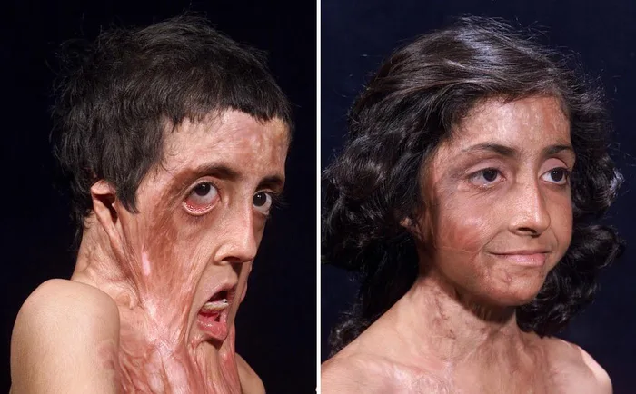 The Remarkable Reconstructive Surgery of Zubaida Hasan